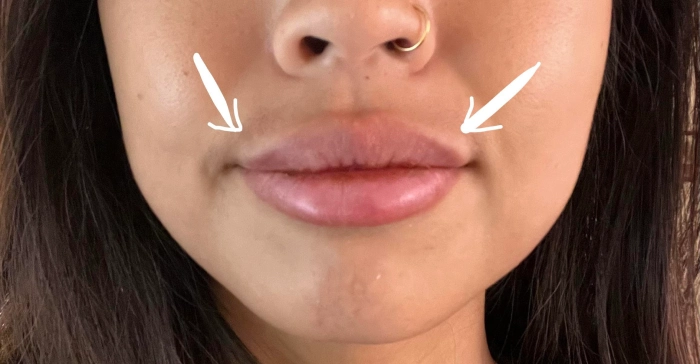 عوارض تزریق ژل لب