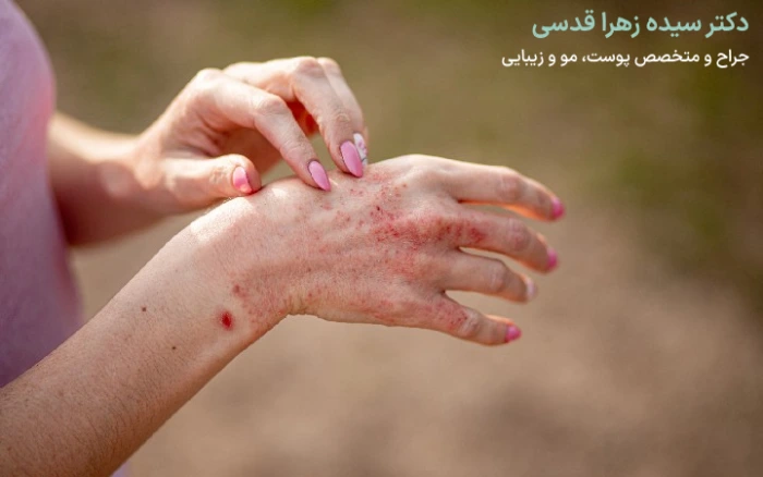 قارچ پوستی چیست؟