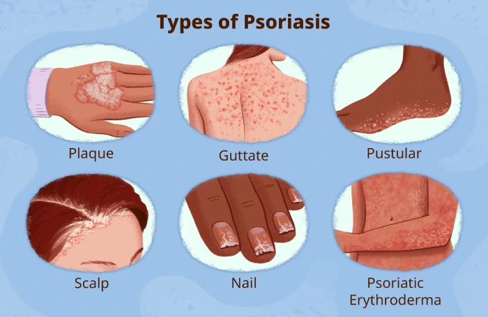 انواع پسوریازیس