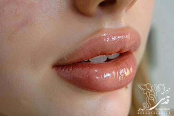 منظور از تزریق ژل لب مدل قلوه ای