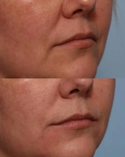 نحوه تزریق ژل خط غم