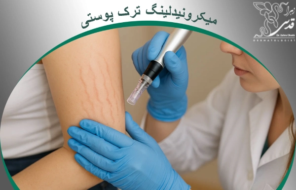 میکرونیدلینگ ترک پوستی