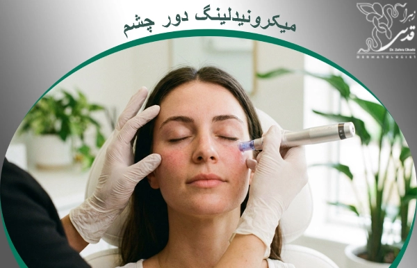 میکرونیدلینگ دور چشم