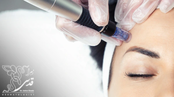 جلسه میکرونیدلینگ