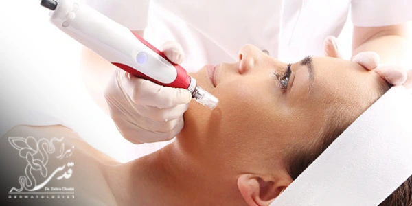 درمان منافذ باز پوست با میکرونیدلینگ