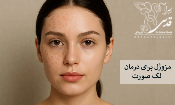 مزوژل برای درمان لک صورت