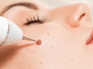 برداشتن خال در غرب تهران