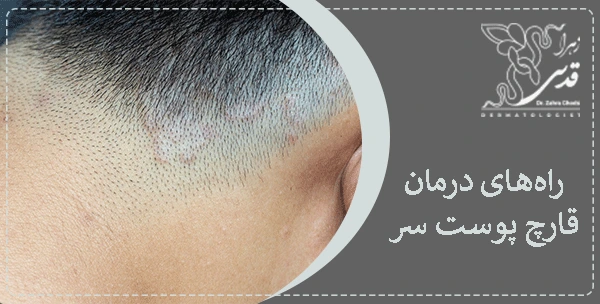 درمان قطعی قارچ پوست سر