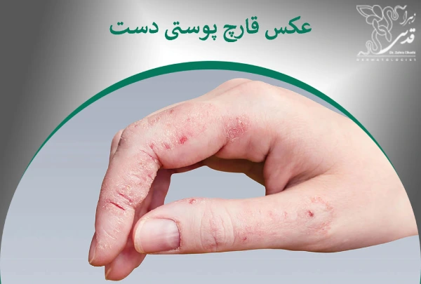 عکس قارچ پوستی دست