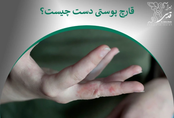 قارچ پوست دست چیست؟