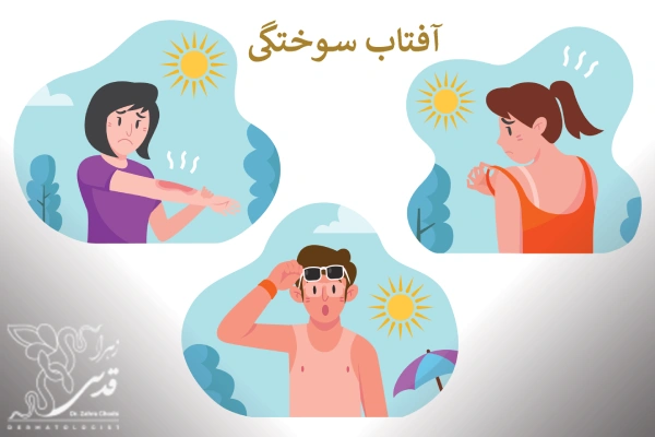 آفتاب سوختگی