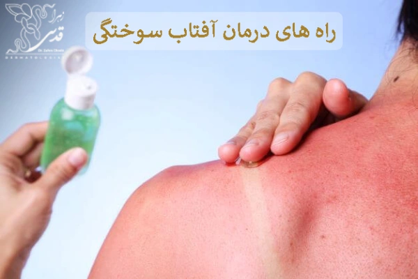 آفتاب سوختگی