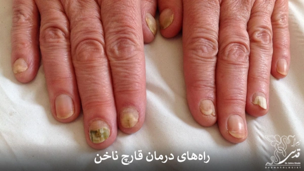 درمان سریع قارچ ناخن