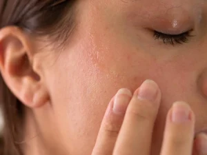 خشکی پوست در تابستان