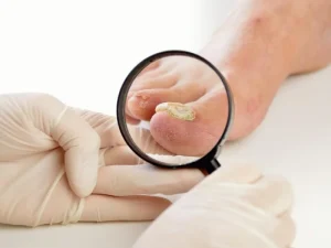 درمان سریع قارچ ناخن