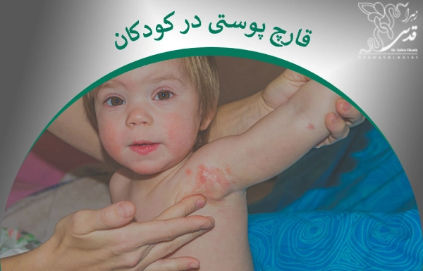 قارچ پوستی در کودکان