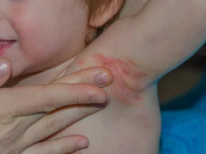 قارچ پوستی در کودکان