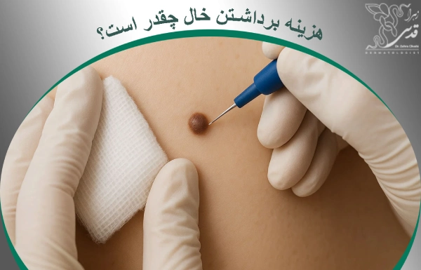 هزینه برداشتن خال