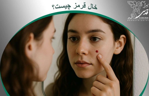 خال قرمز چیست؟