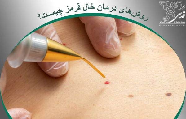 درمان خال قرمز