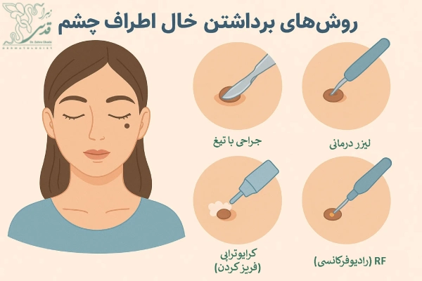 روشهای برداشتن خال اطراف چشم