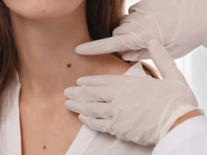 برداشتن خال در بارداری