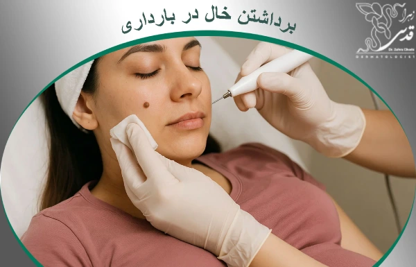 برداشتن خال در بارداری