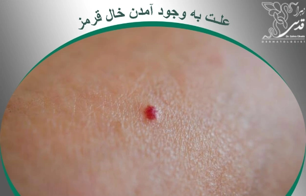 علت به وجود آمدن خال قرمز چیست؟