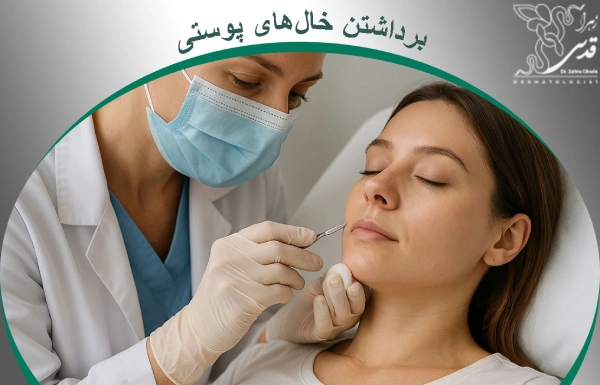 برداشتن خالهای پوستی
